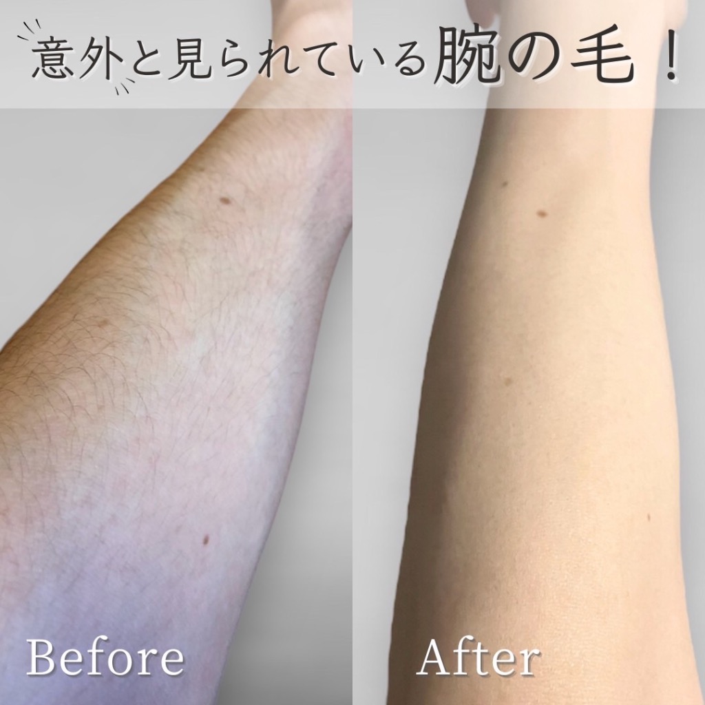 腕脱毛 Before→After✨
