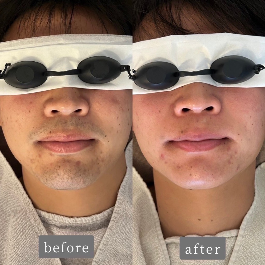 ヒゲ脱毛のお客様Before👉After