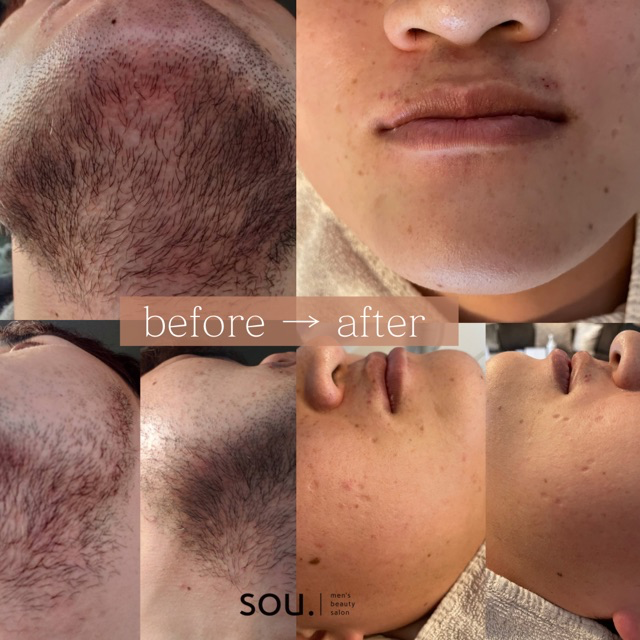 ヒゲ脱毛によってツルツルなお肌に大変身出来ます‼️