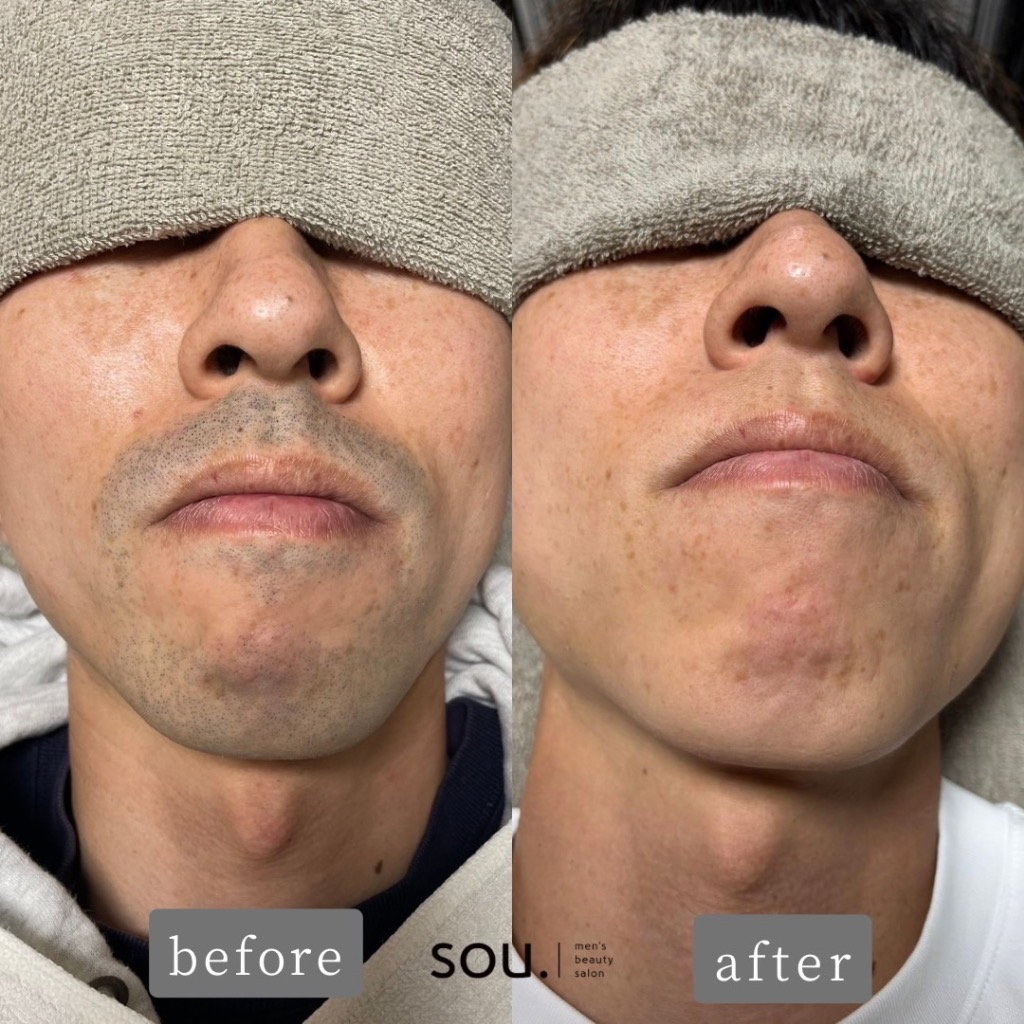 ヒゲ脱毛をされたお客様からいただいたご感想を紹介させていただきます😊