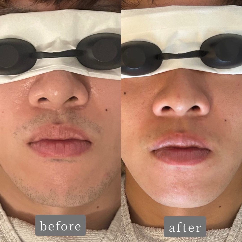 ヒゲ脱毛 Before→After✨