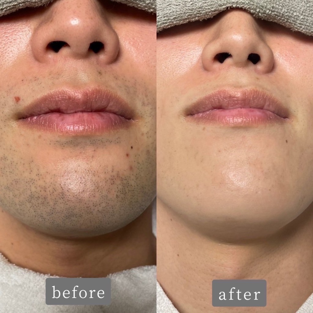 ヒゲ脱毛のお客様Before👉After 