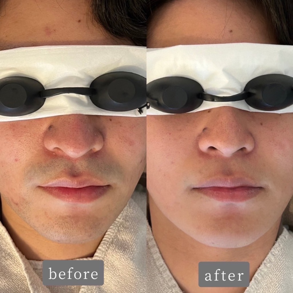 先日、ヒゲ脱毛のお客様にご来店いただき、その際にこうおっしゃっていました💡