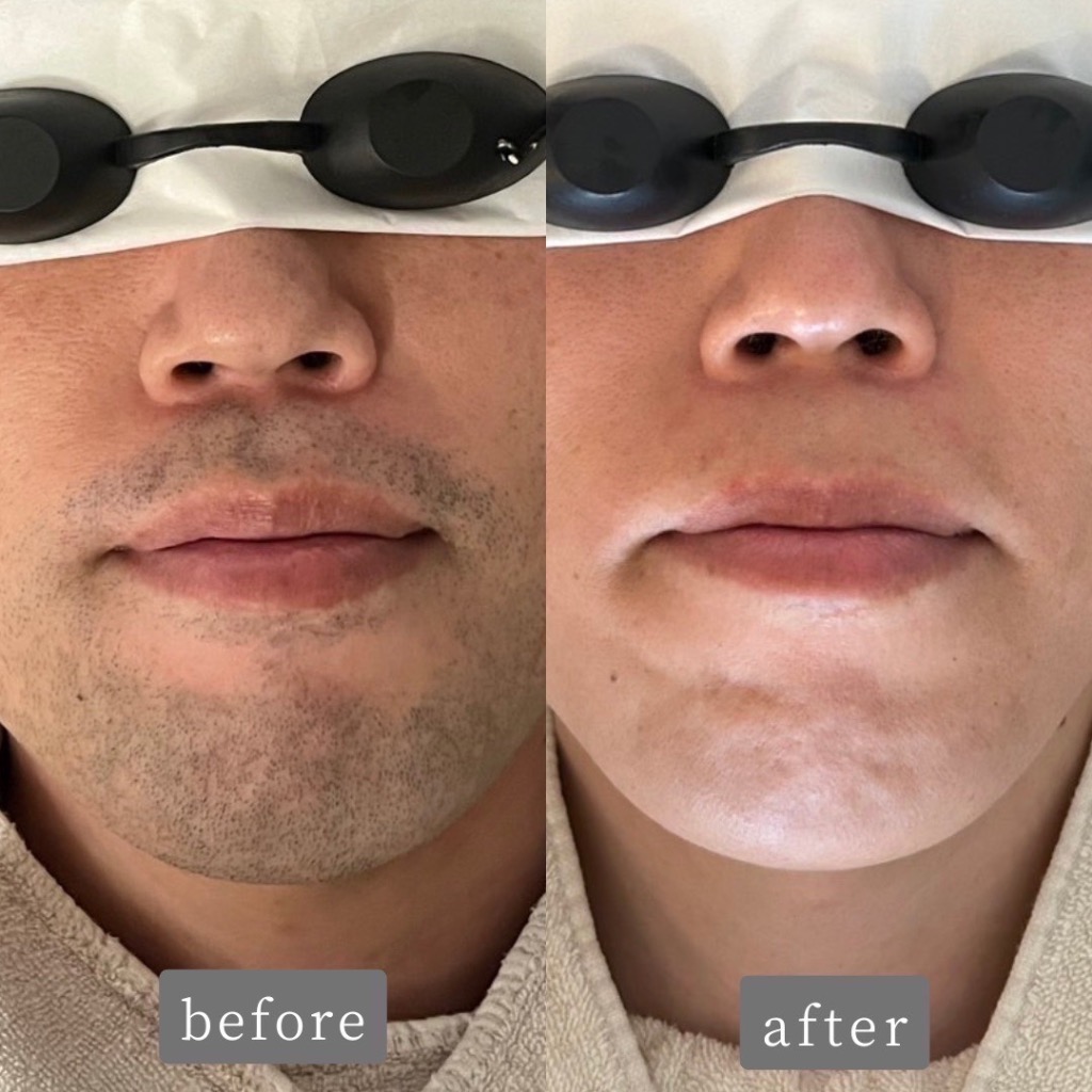 ヒゲ脱毛 Before→After✨