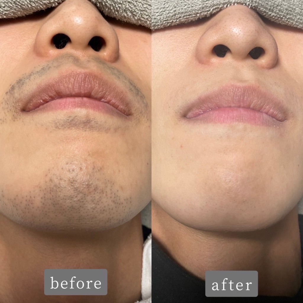 ヒゲ脱毛のお客様Before👉After 