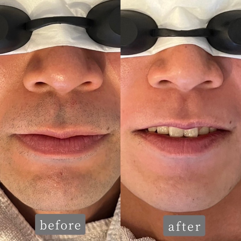 ヒゲ脱毛 Before→After✨