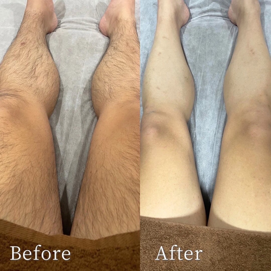 足脱毛 Before 👉After🦵✨