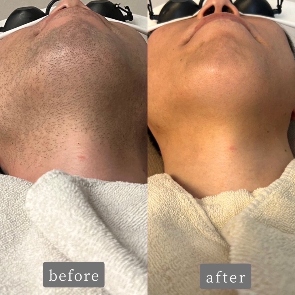 ヒゲ脱毛 Before→After✨