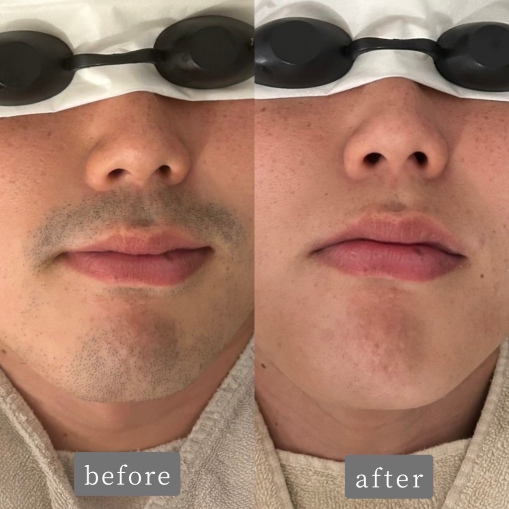 ＼ヒゲでお悩みの男性へ／