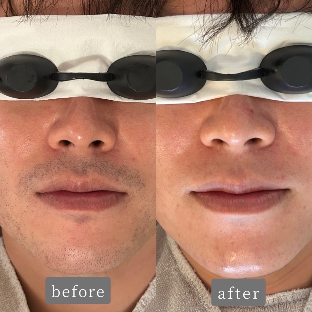 ヒゲ脱毛 Before→After✨