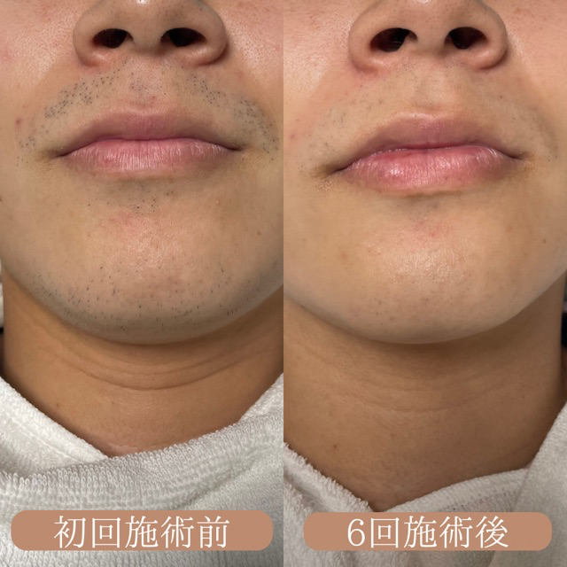 ヒゲ脱毛before👉after✨
