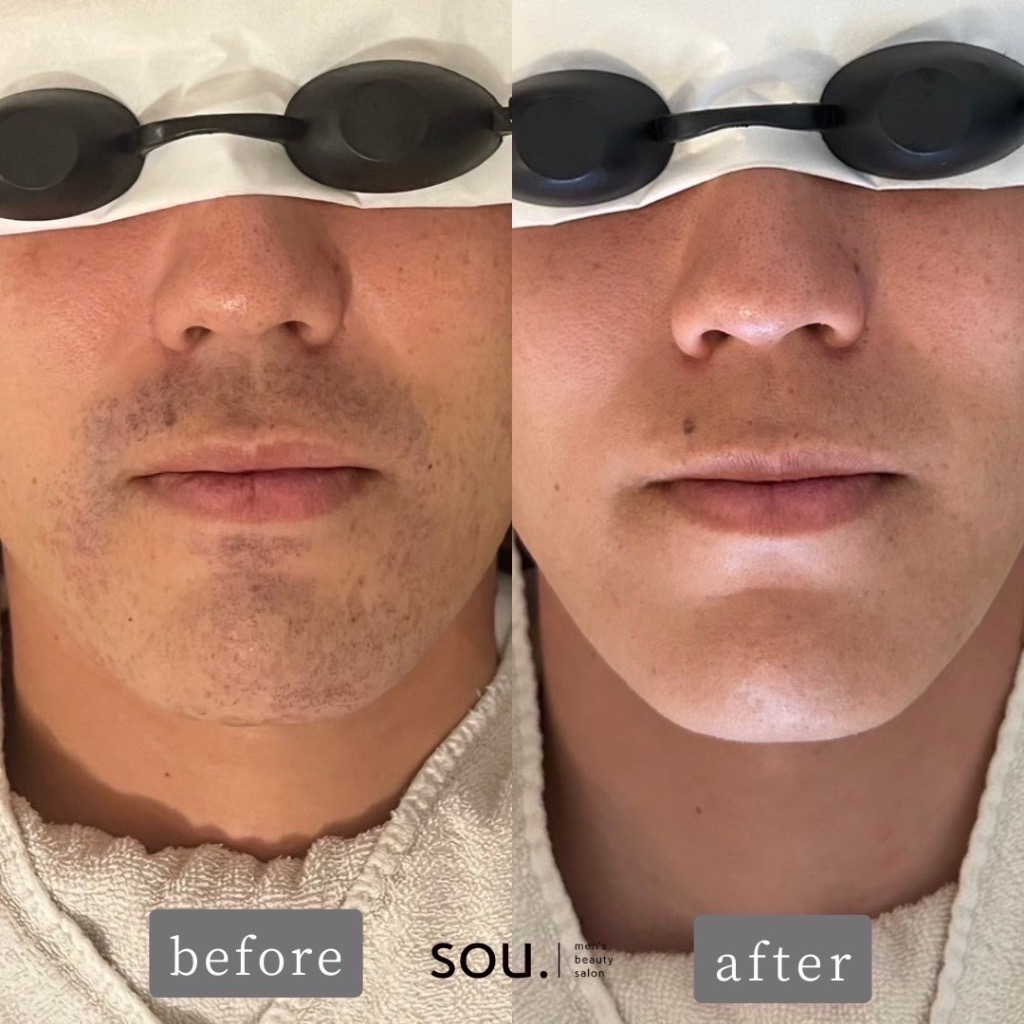 ヒゲ脱毛 Before→After✨