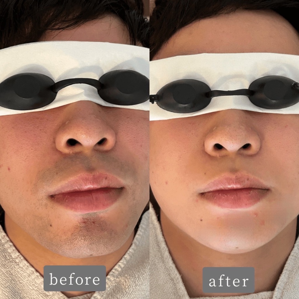 \ヒゲ脱毛Before→After/