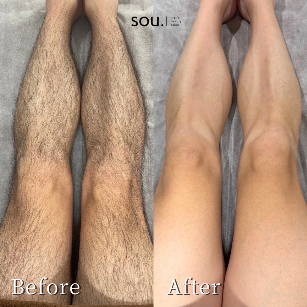 足脱毛 Before👉After🦵✨