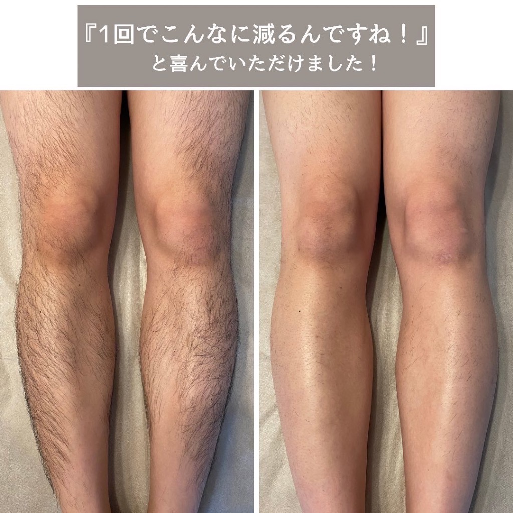 当店人気の足脱毛 Before👉After🦵