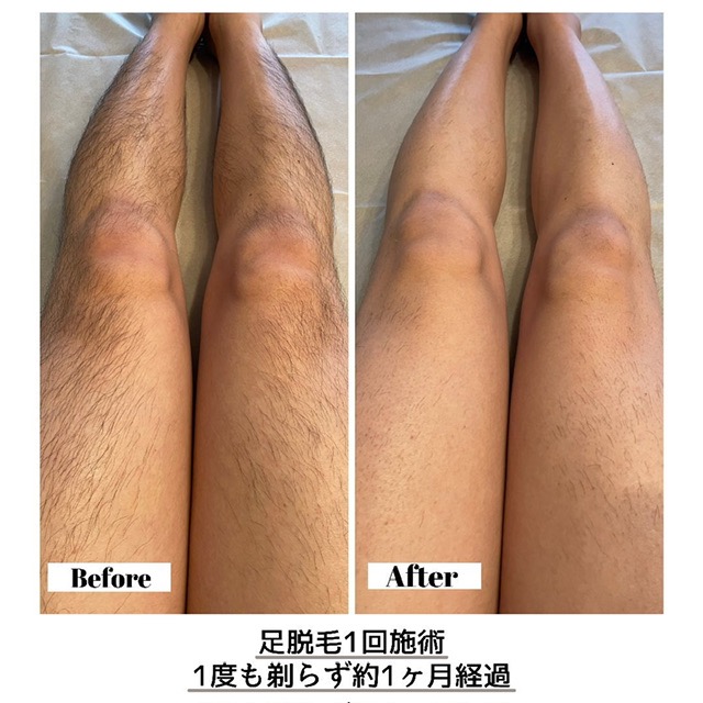 当店人気の足脱毛 Before👉After🦵