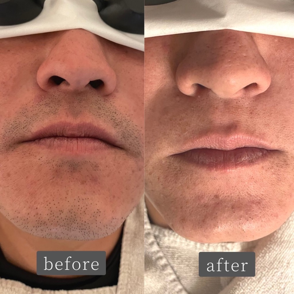 ヒゲ脱毛 Before👉After✨