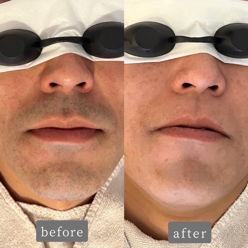 ヒゲ脱毛 Before→After✨