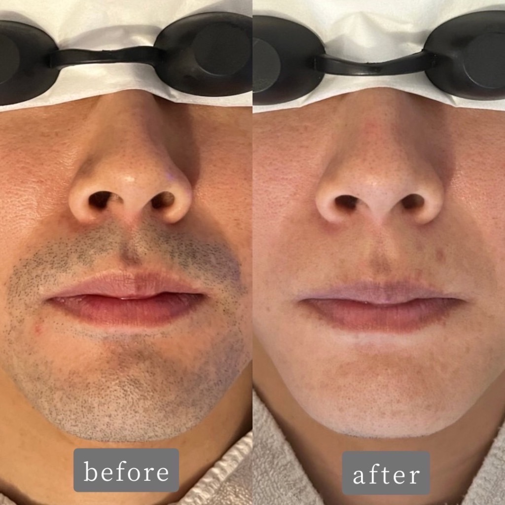 ヒゲ脱毛のお客様Before→After 