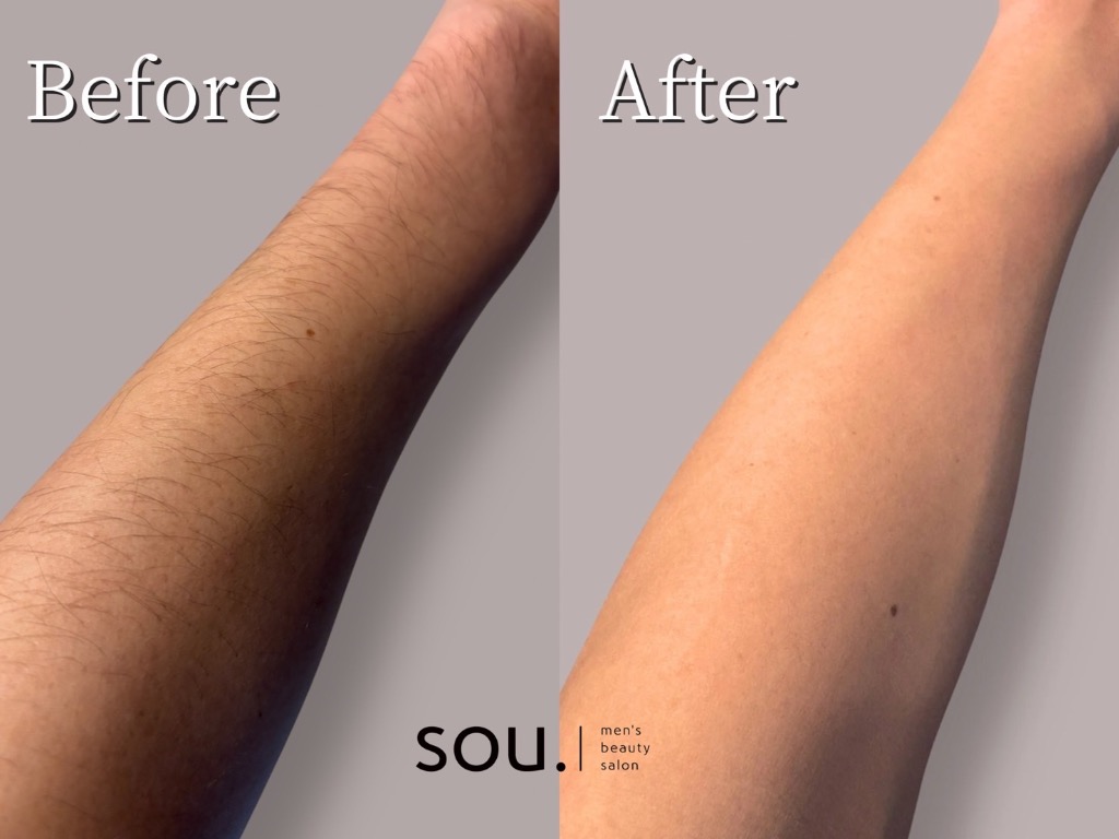 腕脱毛 Before→After✨