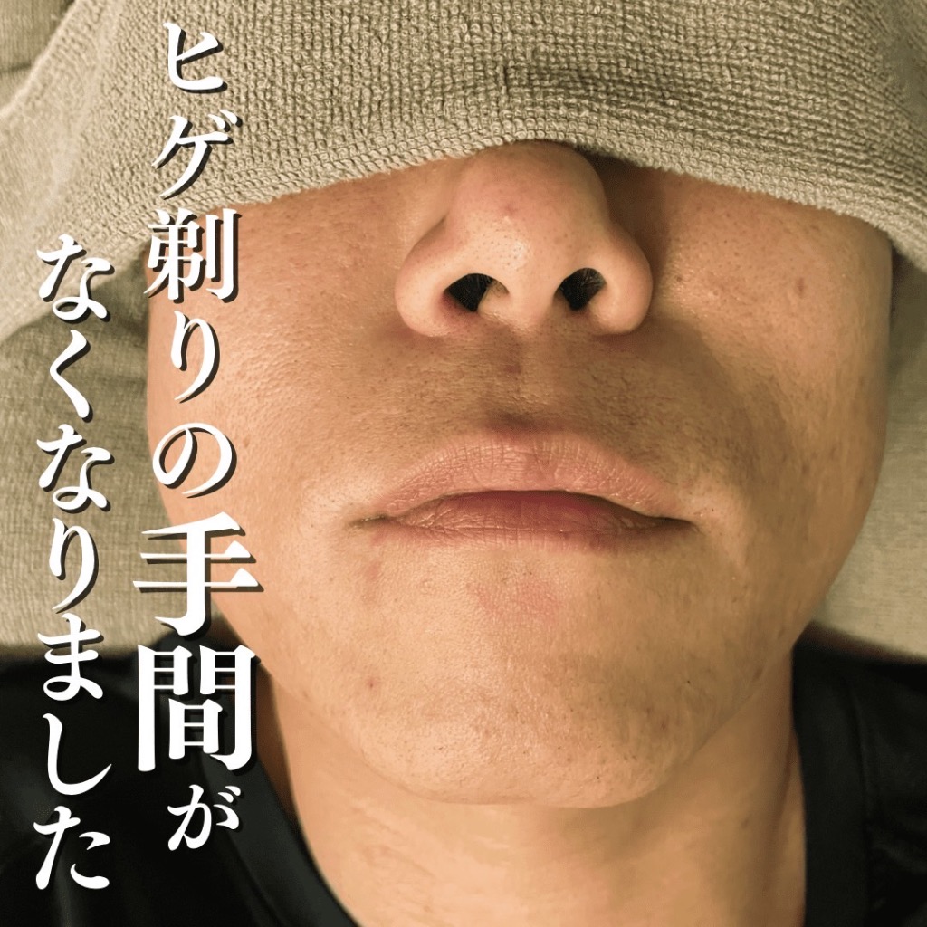 ヒゲ脱毛を完了された40代のお客様で す！✨