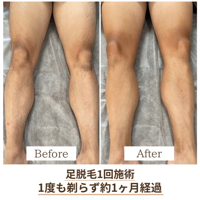 足脱毛 Before👉After🦵✨