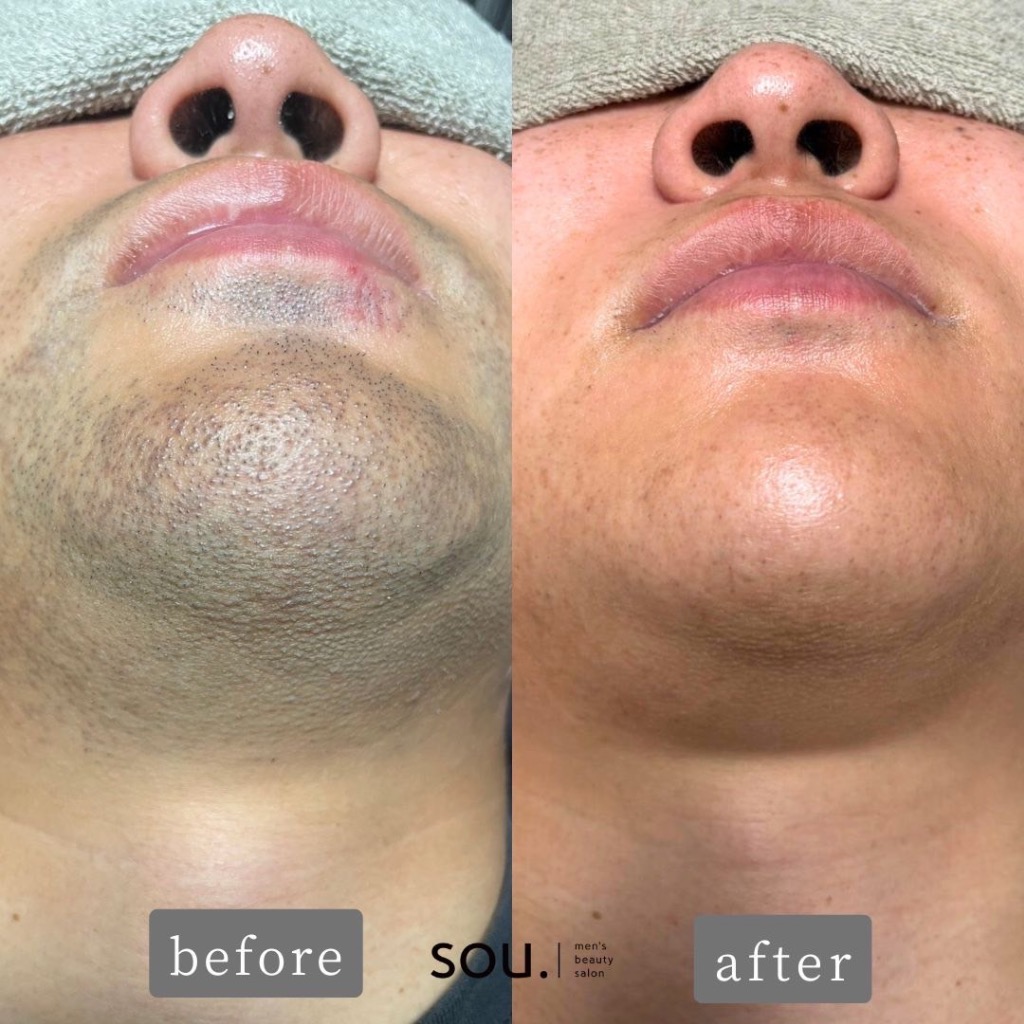 ヒゲ脱毛のお客様Before👉After 