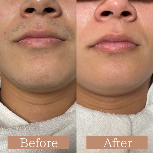ヒゲ脱毛 Before→After✨